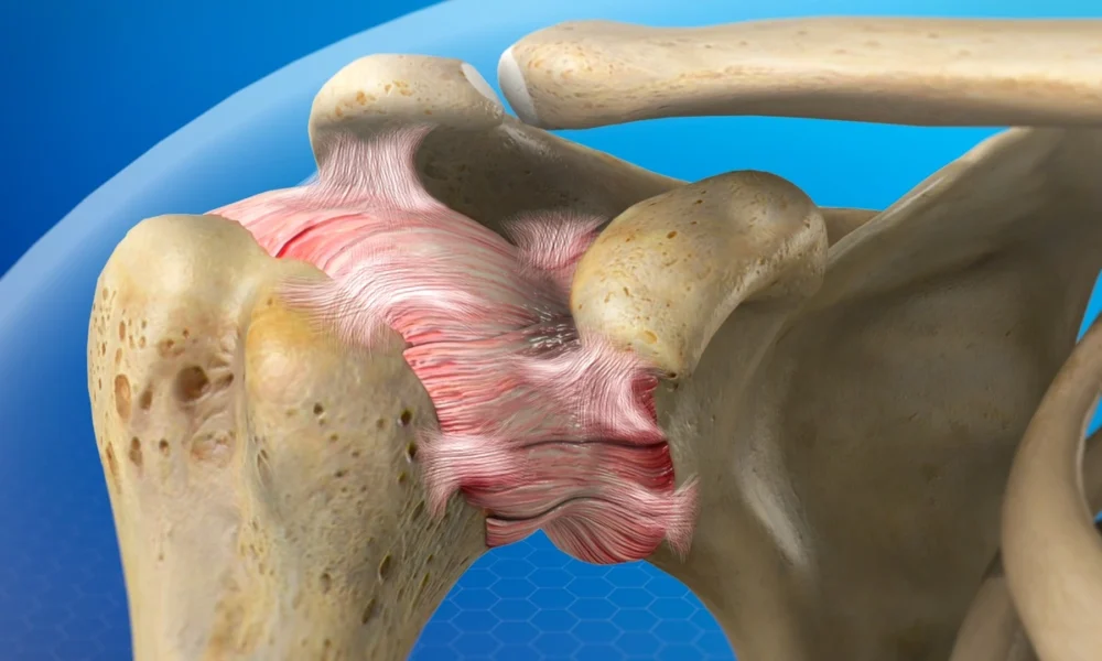 Frozen Shoulder