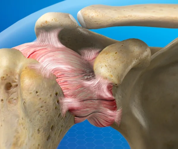Frozen Shoulder
