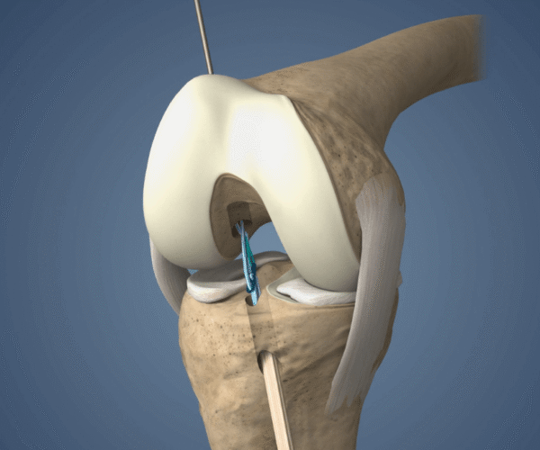 Internal Brace ACL in Ghatkopar